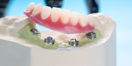 South Jersey Dental Implants