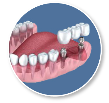South Jersey Multiple Dental Implants