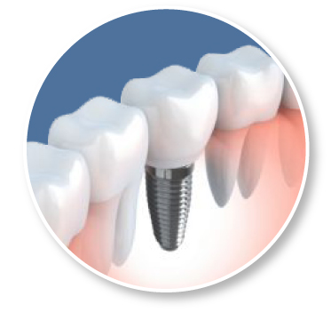 South Jersey Single Tooth Implant