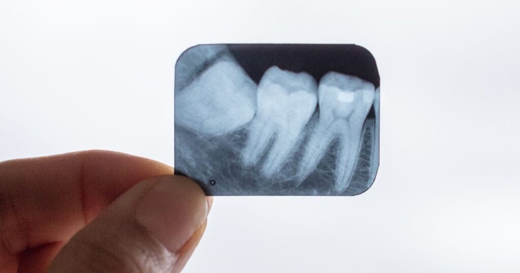 What Should I Expect After I Have My Wisdom Teeth Removed?